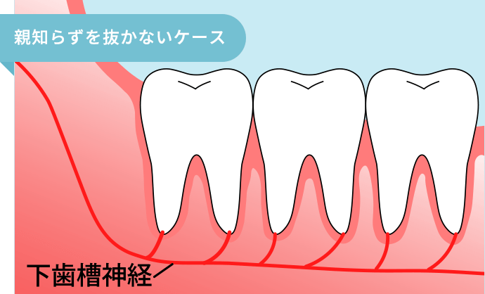 親知らずを抜かないケース