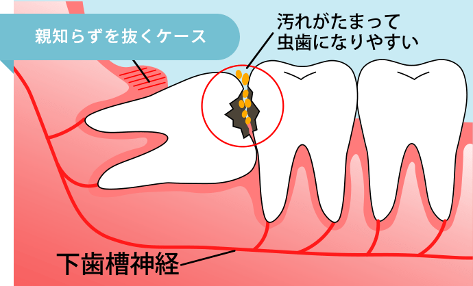 親知らずを抜くケース